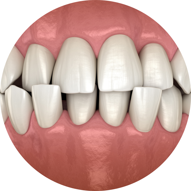 Crossbite