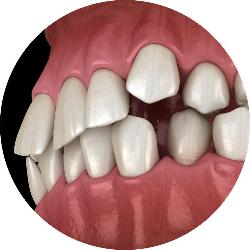 Crowded Teeth