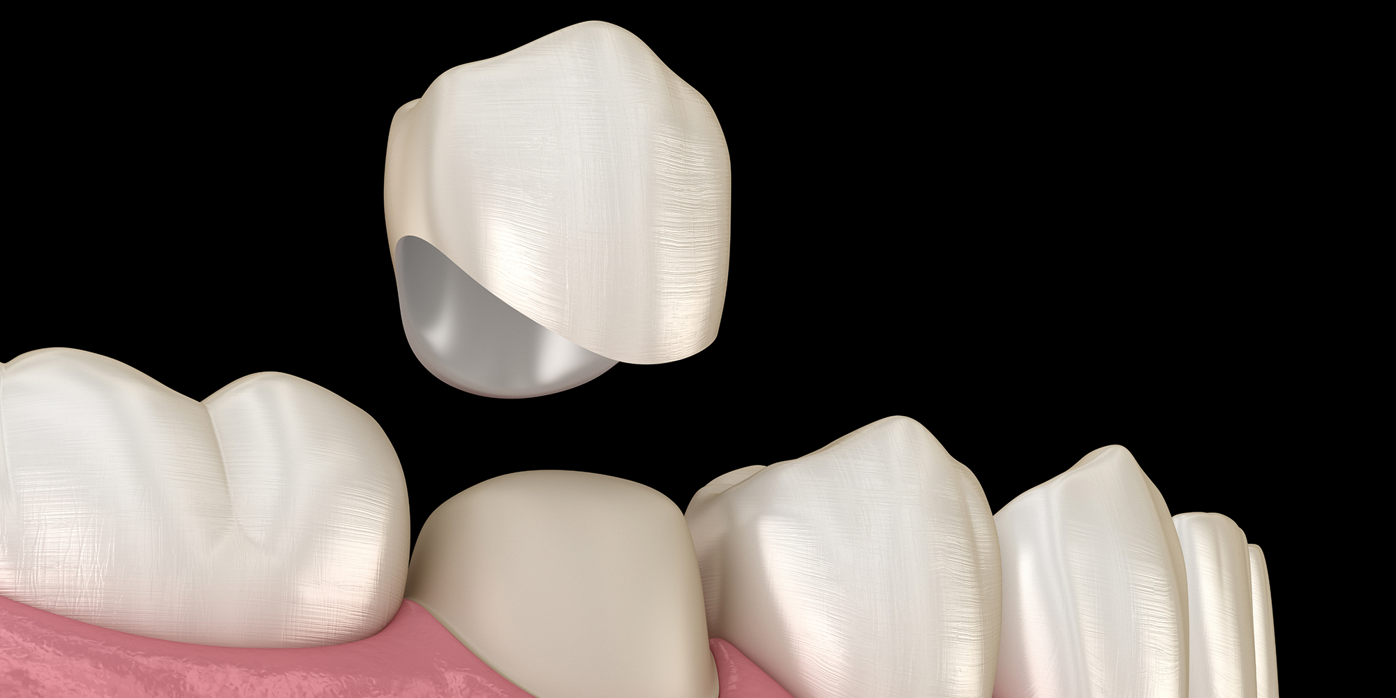 Crown on implant diagram (