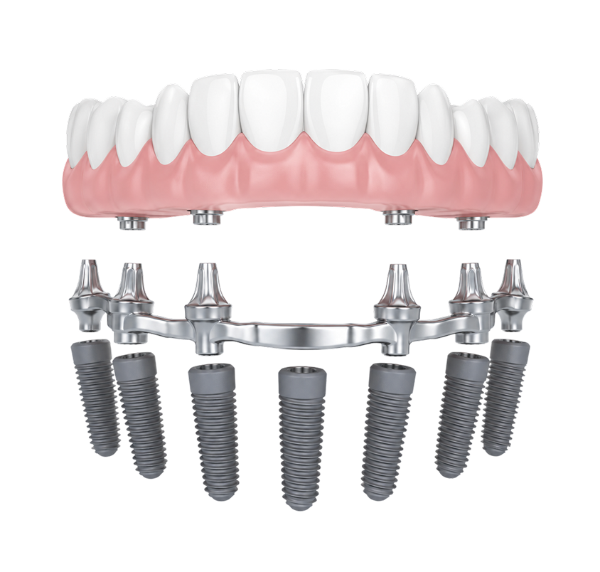 Full-Arch Dental Implants - Diagram