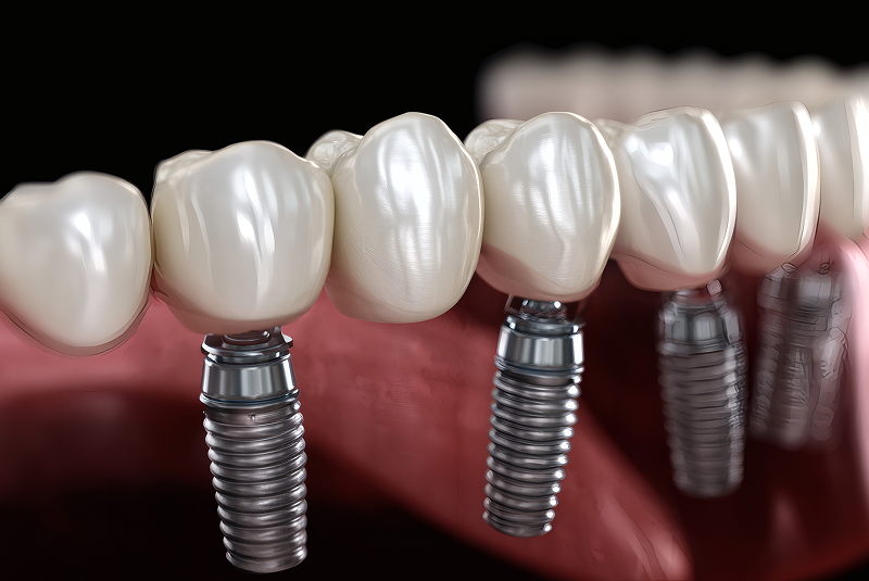 Implant-Supported Bridge