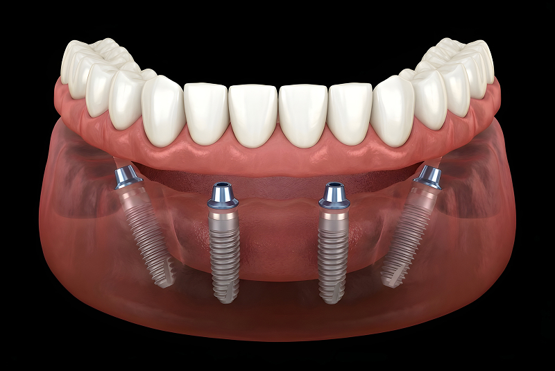 Implant-Supported Dentures