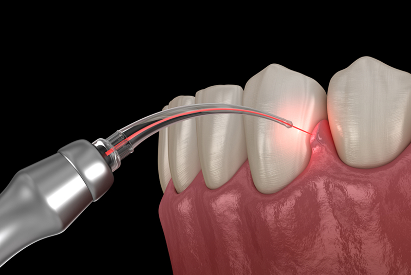 LANAP Laser Surgery