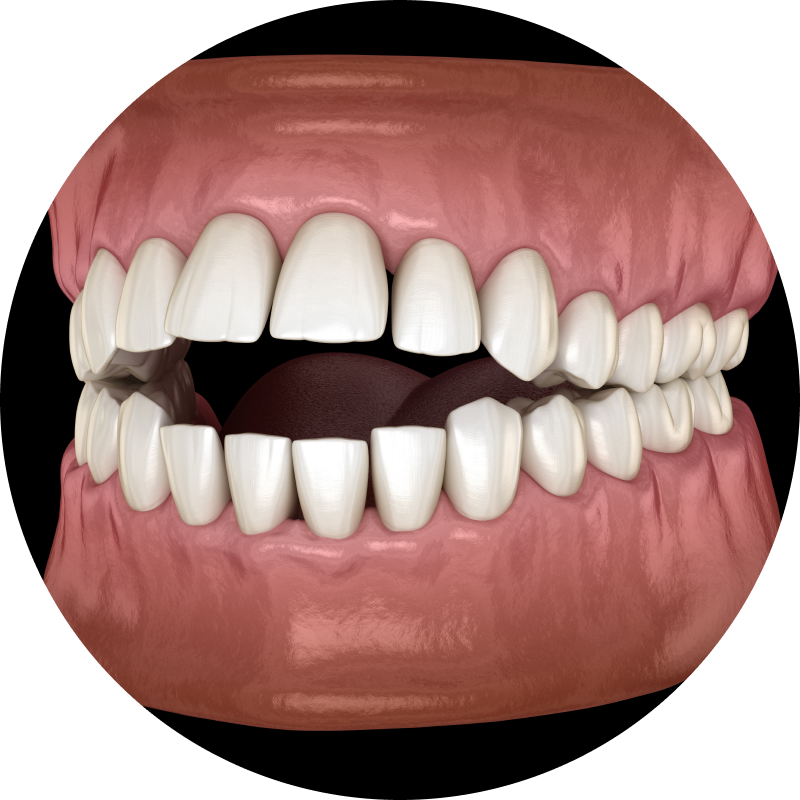 Open Bite