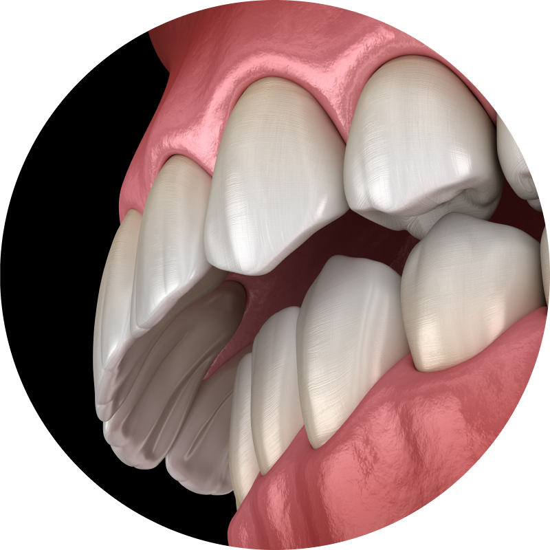 Overbite