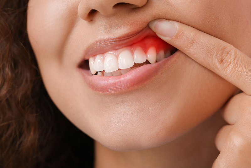 Patient showing infected gums