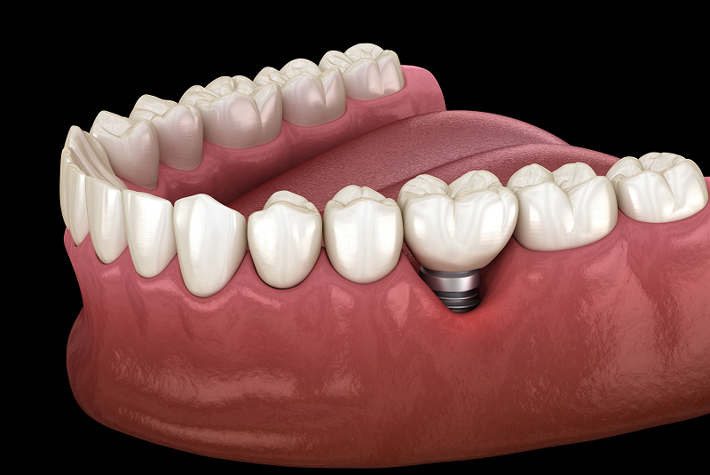 Peri-Implantitis