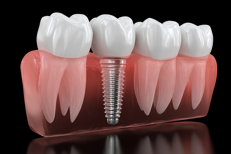 Single Tooth Implant