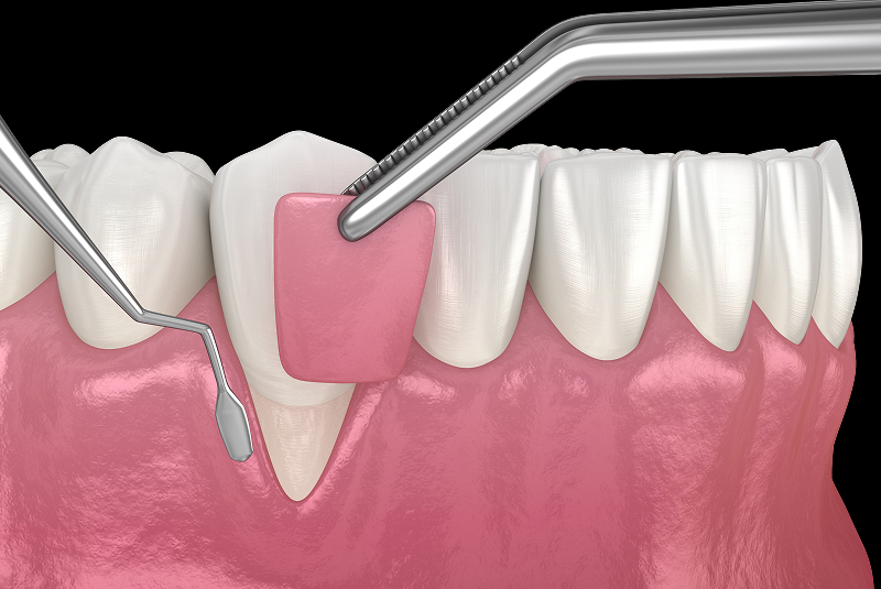 Traditional Gum Surgery