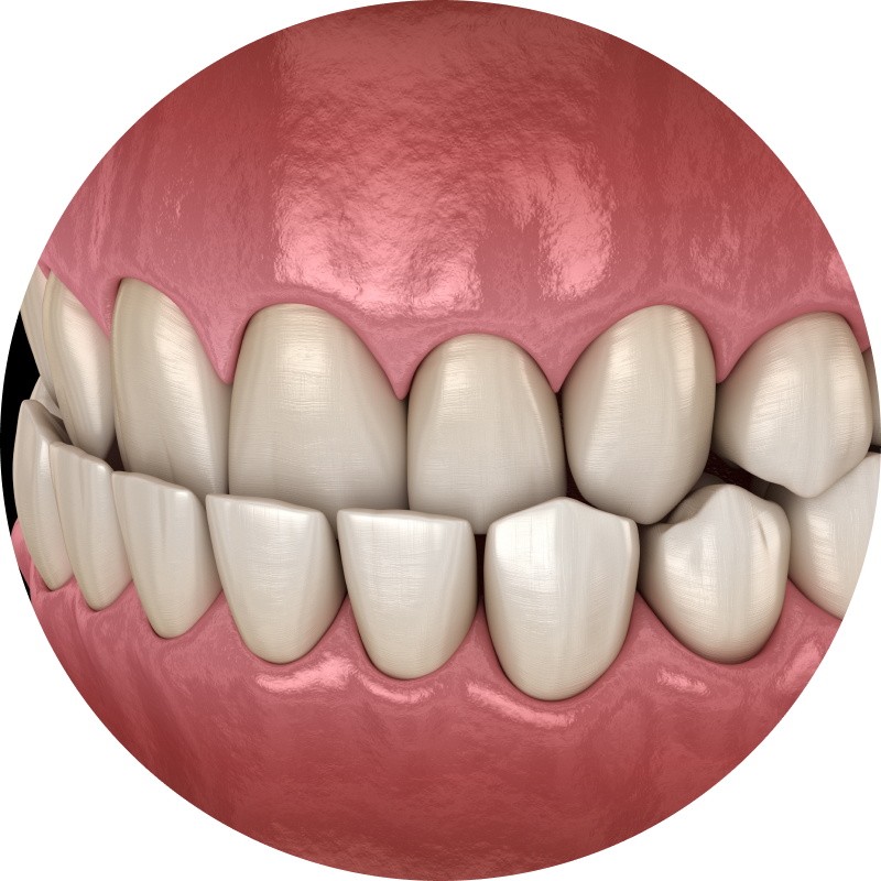 Underbite