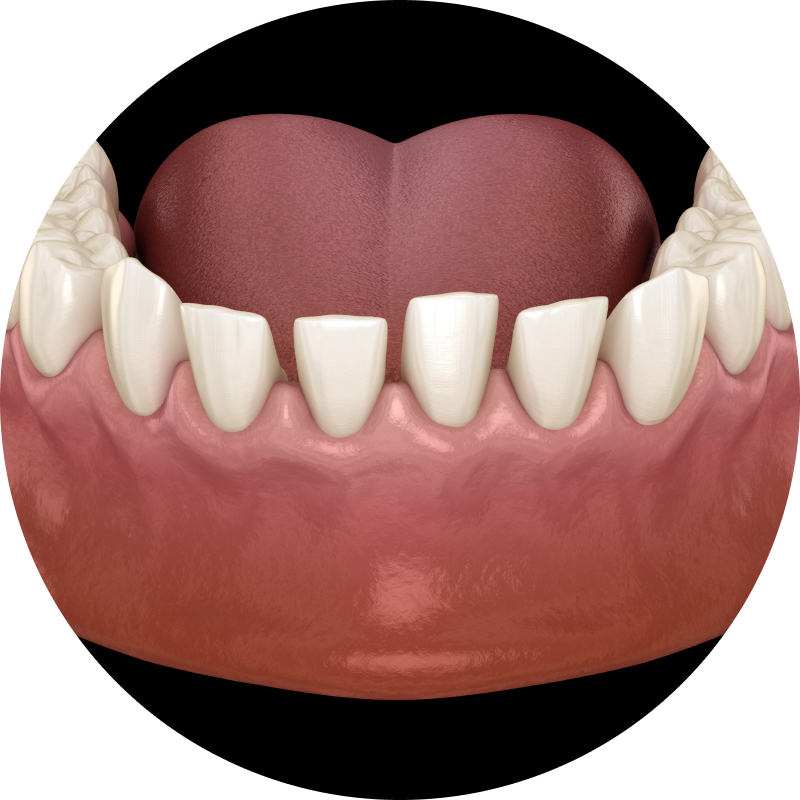 Widely Spaced Teeth