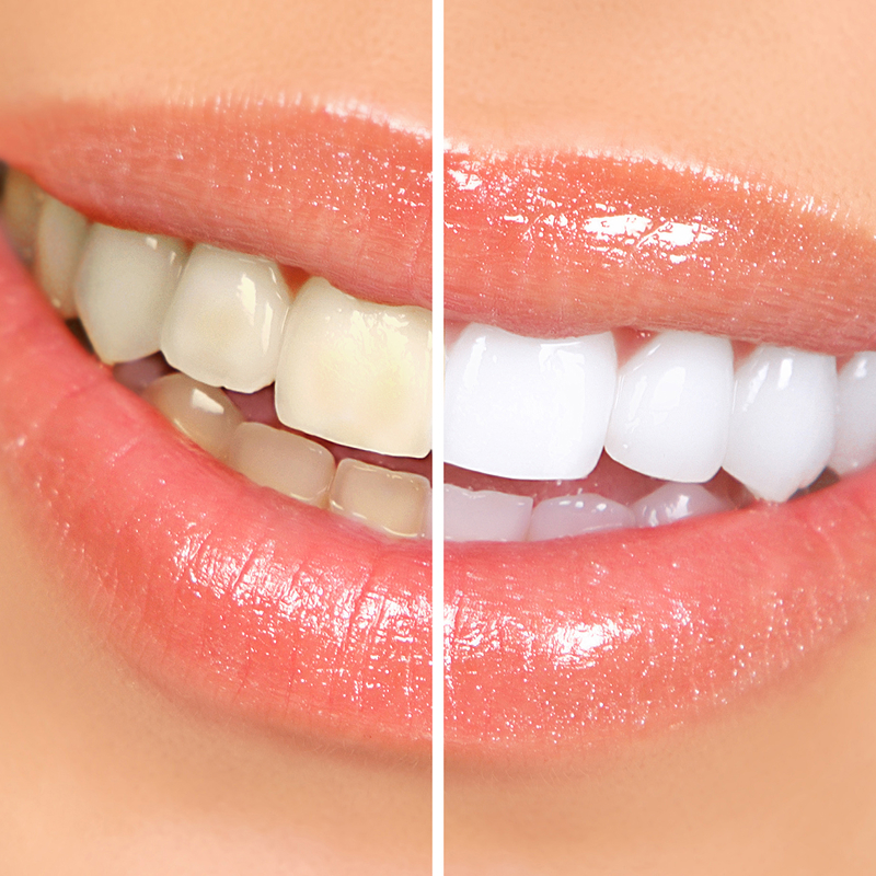 before and after whitening smile