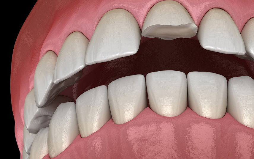 diagram of cracked tooth