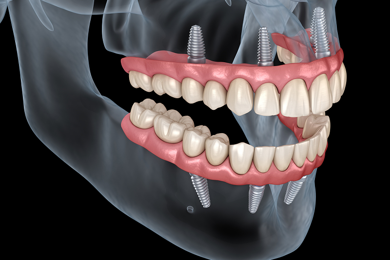 full-arch dental implant diagram