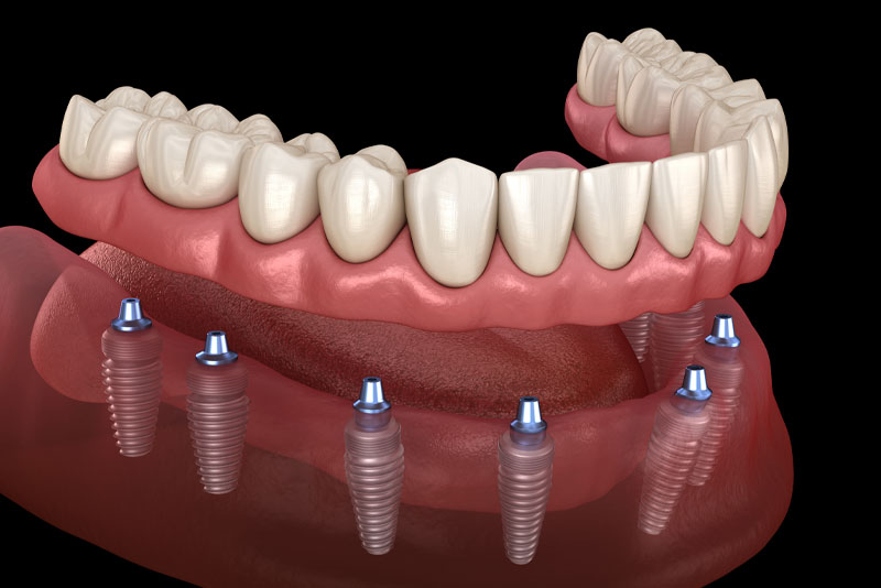 full-mouth-dental-implants-model