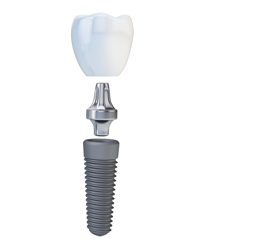 implant model