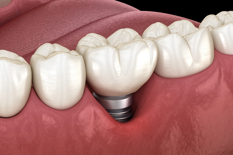 peri-implantitis