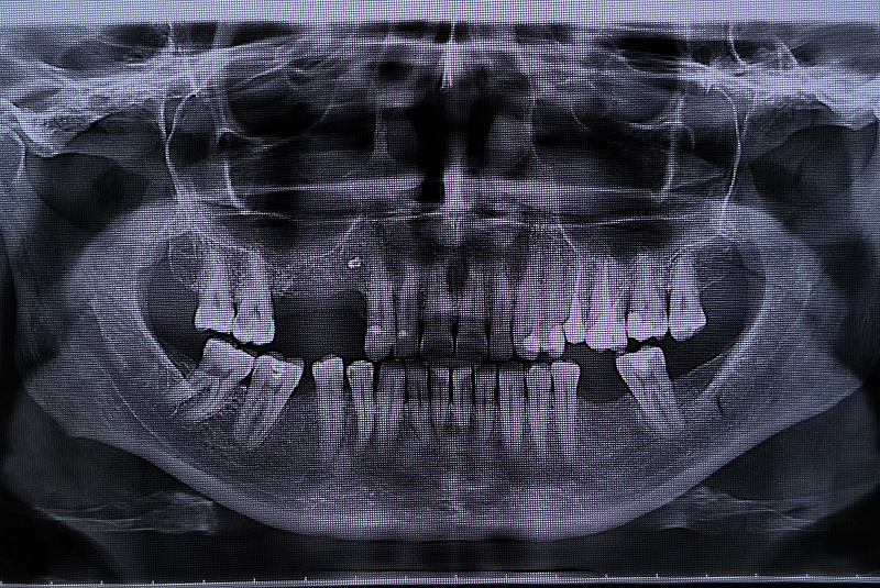 xray of mouth with missing teeth